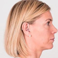 Bernafon Leox BTE UP, Bernafon Kulak Arkası Leox Ultra Power Güçlü İşitme Cihazı, Bernafon UP Çok İleri İşitme Kayıplılar için BTE Kulak Cihazı